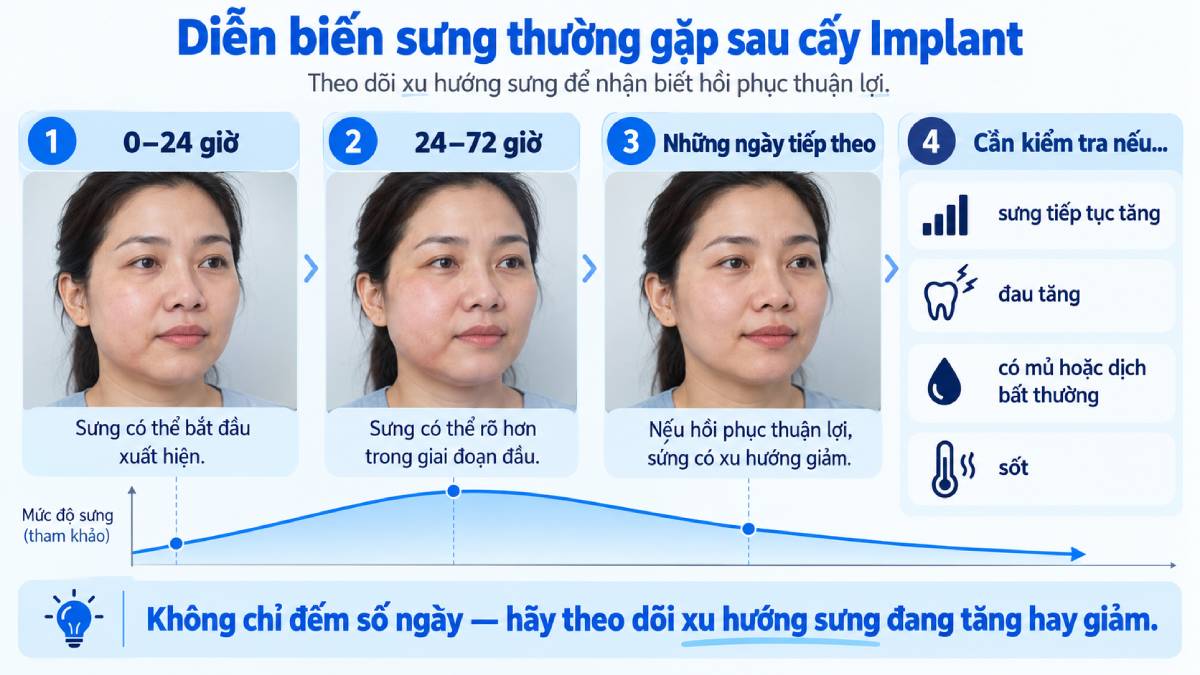 Diễn biến sưng sau cấy Implant cần được theo dõi theo xu hướng. Sưng có thể rõ hơn trong những ngày đầu nhưng nên dần giảm khi quá trình hồi phục thuận lợi.